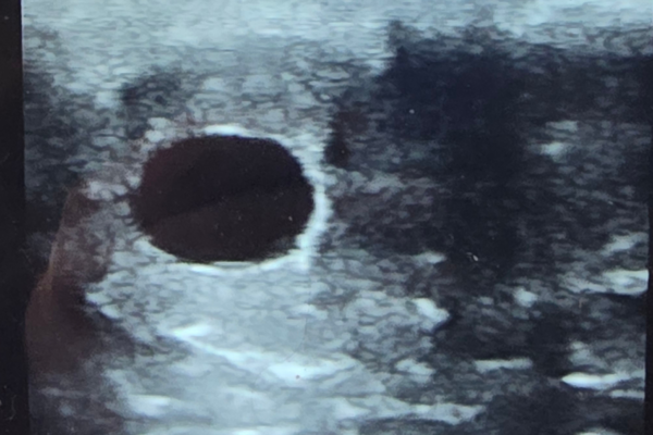 Disarm First Foal Sonogram